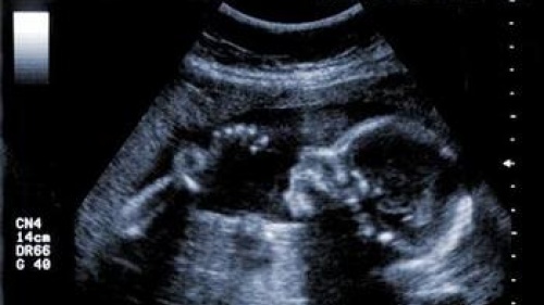 A sonogram of a baby it its mother's womb.
